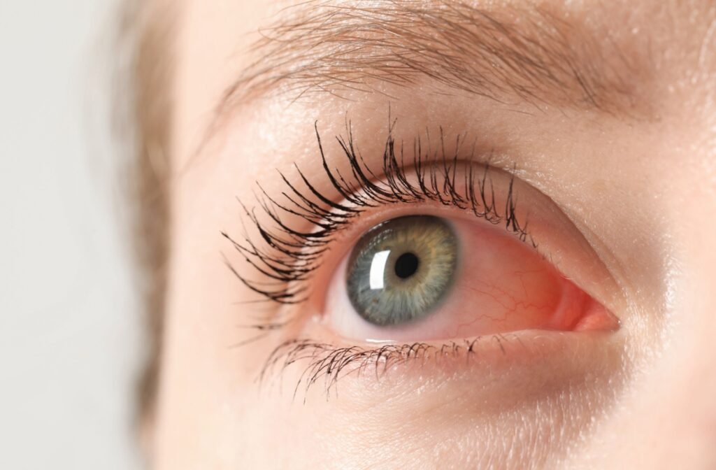 A person with dry eye looks off into the distance. Their eye is red and irritated from their lack of high quality tears.