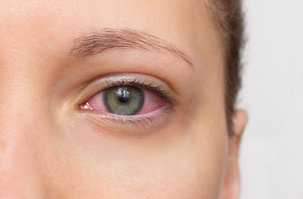 close up of a red eyeball caused by dry eye