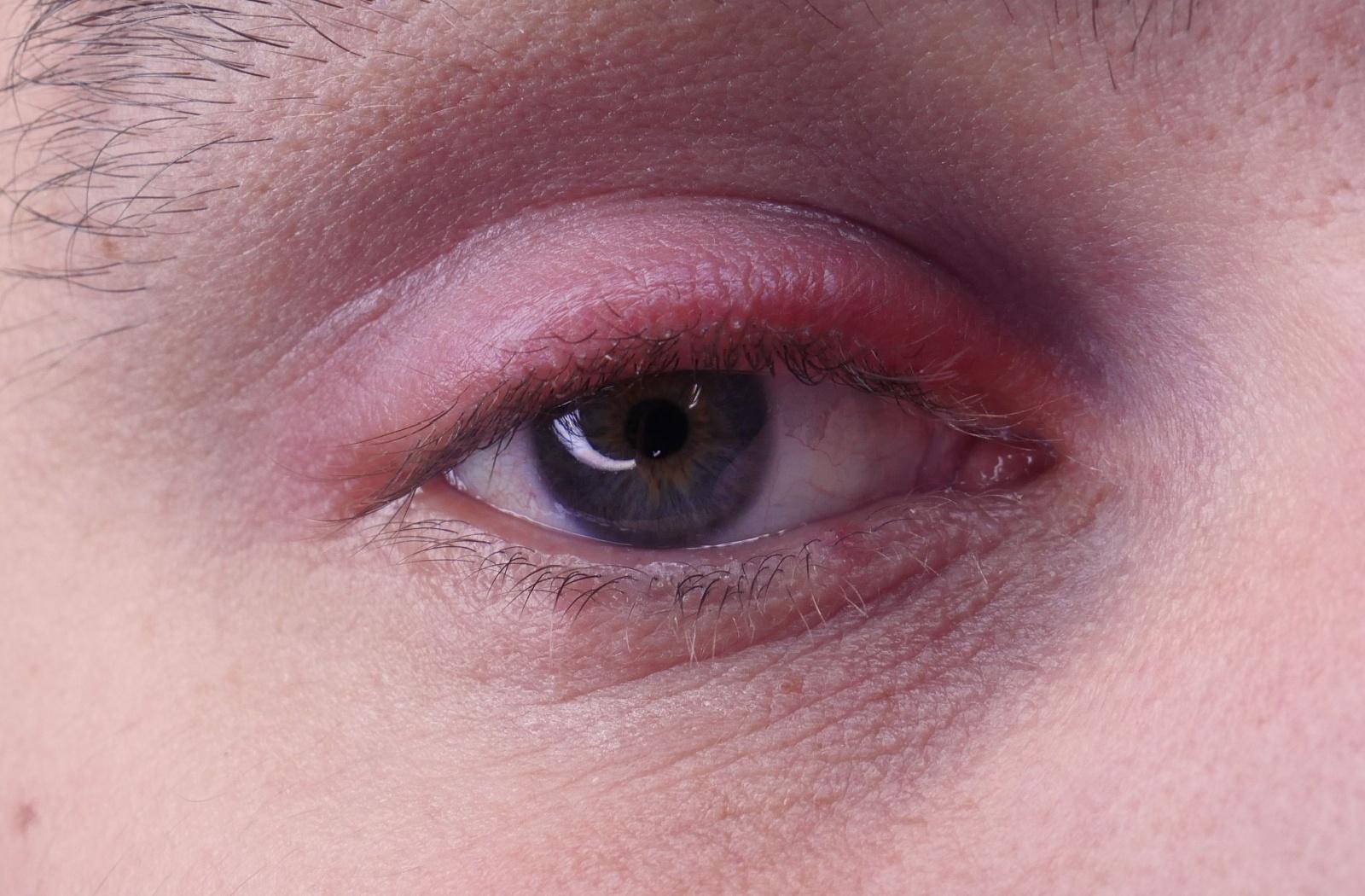 A close up of a red eye caused by conjunctivitis